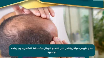 علاج طبيعي مبتكر يقضي على الصلع الوراثي وتساقط الشعر بدون جراحة أو أدوية